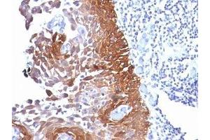 Formalin-fixed, paraffin-embedded human cervical carcinoma stained with Cytokeratin 18 antibody. (Cytokeratin 18 抗体)