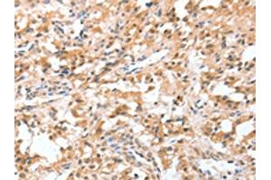 The image on the left is immunohistochemistry of paraffin-embedded Human thyroid cancer tissue using ABIN7128947(CIDEC Antibody) at dilution 1/50, on the right is treated with fusion protein.