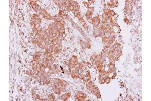 IHC-P Image Immunohistochemical analysis of paraffin-embedded human breast cancer, using PIM2, antibody at 1:250 dilution. (PIM2 抗体  (Center))