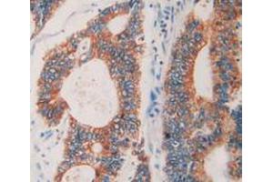 IHC-P analysis of Human Rectum Cancer Tissue, with DAB staining. (Prolactin Receptor 抗体  (AA 25-234))