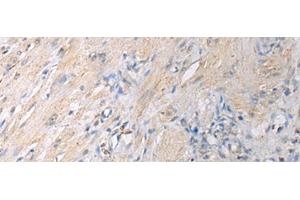 Immunohistochemistry of paraffin-embedded Human gastric cancer tissue using GNAI1 Polyclonal Antibody at dilution of 1:130(x200) (GNAI1 抗体)