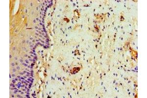Immunohistochemistry of paraffin-embedded human cervical cancer using ABIN7144328 at dilution of 1:100 (TAP1 抗体  (AA 524-808))