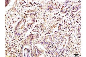 Formalin-fixed and paraffin embedded human colon carcinoma tissue labeled with Anti Phospho-MAP3K8/Tpl2 (Ser400) Polyclonal Antibody, Unconjugated (ABIN746573) at 1:200 followed by conjugation to the secondary antibody and DAB staining. (MAP3K8 抗体  (pSer400))