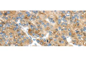 Immunohistochemistry of paraffin-embedded Human liver cancer using TMED4 Polyclonal Antibody at dilution of 1/45 (TMED4 抗体)