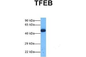 Host:  Rabbit  Target Name:  TFEB  Sample Tissue:  Human Lung Tumor  Antibody Dilution:  1. (TFEB 抗体  (Middle Region))