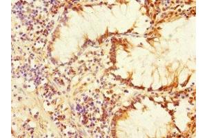Immunohistochemistry of paraffin-embedded human colon cancer using ABIN7169162 at dilution of 1:100 (PLK3 抗体  (AA 487-646))
