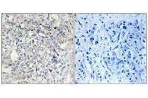 Immunohistochemistry analysis of paraffin-embedded human liver carcinoma tissue, using Heparin Cofactor II antibody. (SERPIND1 抗体)