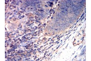Immunohistochemical analysis of paraffin-embedded rectum cancer tissues using CD163 mouse mAb with DAB staining. (CD163 抗体  (AA 42-259))