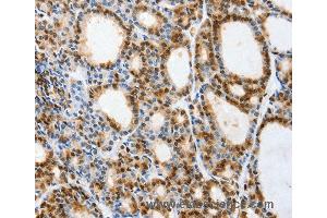 Immunohistochemistry of Human thyroid cancer using VIMP Polyclonal Antibody at dilution of 1:40 (Selenoprotein S 抗体)