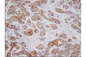Immunohistochemistry: Human breast carcinoma tissues were incubated with anti-human TPD52L1 (1:200) for o/n at room temperature. (TPD52L1 抗体)