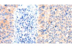 Immunohistochemistry of paraffin-embedded Human cervical cancer tissue using ANK3 Polyclonal Antibody at dilution 1:50 (Ankyrin G 抗体)