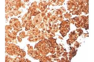 Formalin-fixed, paraffin-embedded human pancreas stained with KRT6A Recombinant Mouse Monoclonal Antibody (rKRT6A/2100). (Recombinant KRT6A 抗体)