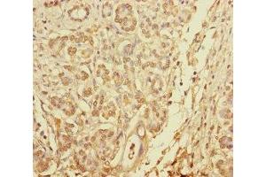 Immunohistochemistry of paraffin-embedded human pancreatic cancer using ABIN7145610 at dilution of 1:100 (Pallidin 抗体  (AA 1-170))