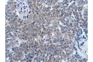 Immunohistochemistry of paraffin-embedded human thyroid cancer using ABIN7190935 at dilution of 1:20 (HES1 抗体)