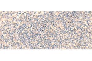 Immunohistochemistry of paraffin-embedded Human tonsil tissue using ADAMTS2 Polyclonal Antibody at dilution of 1:45(x200) (Adamts2 抗体)