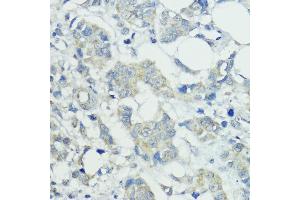 Immunohistochemistry of paraffin-embedded human mammary cancer using SOCS5 antibody (ABIN6128734, ABIN6148271, ABIN6148272 and ABIN6223959) at dilution of 1:100 (40x lens).