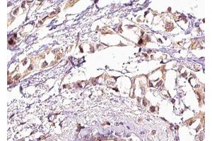 ABIN6267581 at 1/100 staining human breast carcinoma tissue sections by IHC-P. (HSF1 抗体  (pSer303))