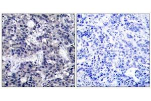 Immunohistochemical analysis of paraffin-embedded human breast carcinoma tissue using PKR (Ab-446) antibody (E021272). (EIF2AK2 抗体)