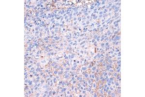 Immunohistochemistry of paraffin-embedded human esophageal cancer using PD-L1/CD274 Rabbit pAb (ABIN6129976, ABIN6138153, ABIN6138154 and ABIN6215142) at dilution of 1:100 (40x lens). (PD-L1 抗体  (AA 19-238))