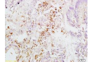 Formalin-fixed and paraffin embedded human rectal carcinoma labeled with Anti-Integrin beta 3/CD61 Polyclonal Antibody, Unconjugated  at 1:200, followed by conjugation to the secondary antibody and DAB staining (Integrin beta 3 抗体  (AA 27-120))