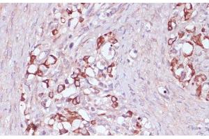 Immunohistochemistry of paraffin-embedded Human oophoroma using UGT2B15 Polyclonal Antibody at dilution of 1:100 (40x lens). (UGT2B15 抗体)