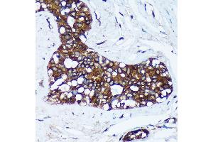 Immunohistochemistry of paraffin-embedded Human breast cancer using MRPL30 Rabbit pAb (ABIN7268567) at dilution of 1:100 (40x lens). (MRPL30 抗体  (AA 1-161))