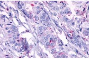 Immunohistochemistry (Formalin/PFA-fixed paraffin-embedded sections) of human colon cancer, neoplastic cells with GPR124 polyclonal antibody . (GPR124 抗体  (Extracellular Domain))
