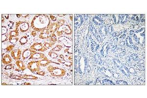 Immunohistochemistry analysis of paraffin-embedded human colon carcinoma tissue, using RPS19 antibody. (RPS19 抗体  (Internal Region))