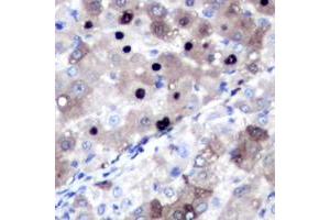 Immunohistochemical analysis of Topoisomerase 2 alpha staining in human liver cancer formalin fixed paraffin embedded tissue section. (Topoisomerase II alpha 抗体  (N-Term))