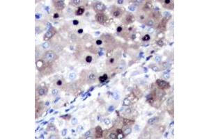 Immunohistochemical analysis of Topoisomerase 2 alpha staining in human liver cancer formalin fixed paraffin embedded tissue section.