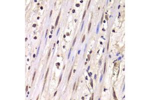 Immunohistochemistry of paraffin-embedded human mammary cancer using LSM4 antibody. (LSM4 抗体  (AA 1-139))