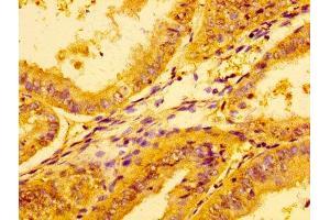 Immunohistochemistry of paraffin-embedded human endometrial cancer using ABIN7157794 at dilution of 1:100 (Lactate Dehydrogenase A 抗体  (AA 5-323))