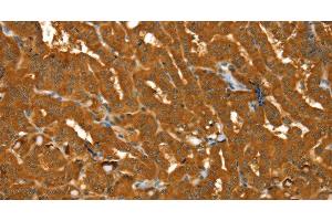 Immunohistochemistry of paraffin-embedded Human thyroid cancer using PYGM Polyclonal Antibody at dilution of 1:30 (PYGM 抗体)