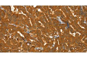 Immunohistochemistry of paraffin-embedded Human thyroid cancer using PYGM Polyclonal Antibody at dilution of 1:30