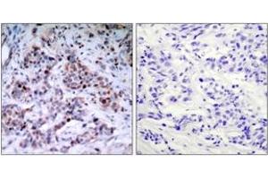Immunohistochemistry analysis of paraffin-embedded human breast carcinoma, using NF-kappaB p65 (Phospho-Thr435) Antibody.