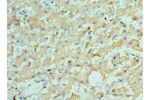 Immunohistochemistry of paraffin-embedded human liver cancer using ABIN7157649 at dilution of 1:100 (KIF2C 抗体  (AA 1-190))