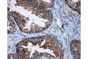 Immunohistochemical staining of paraffin-embedded Carcinoma of liver tissue using anti-FAHD2A mouse monoclonal antibody. (FAHD2A 抗体)