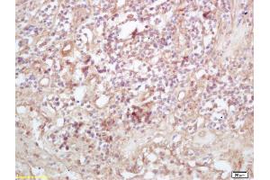 Formalin-fixed and paraffin embedded human lung carcinoma labeled with Rabbit Anti Exportin 1/CRM1 Polyclonal Antibody, Unconjugated (ABIN1714155) at 1:200 followed by conjugation to the secondary antibody and DAB staining (XPO1 抗体  (AA 701-800))