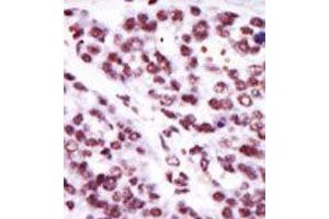 Formalin-fixed and paraffin-embedded human cancer tissue reacted with the primary antibody, which was peroxidase-conjugated to the secondary antibody, followed by AEC staining. (PKC epsilon 抗体  (N-Term))