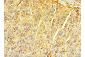 Immunohistochemistry of paraffin-embedded human liver cancer using ABIN7161741 at dilution of 1:100 (NTRK3 抗体  (AA 40-300))
