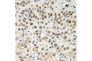 Immunohistochemistry of paraffin-embedded human lung cancer using MSH6 antibody at dilution of 1:100 (400x lens). (MSH6 抗体)