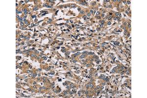 Immunohistochemistry of Human liver cancer using HSD17B12 Polyclonal Antibody at dilution of 1:30 (HSD17B12 抗体)