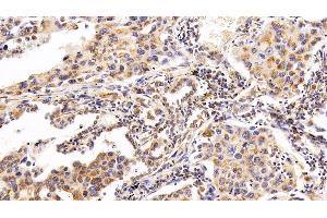 Detection of RNASE3 in Human Lung cancer Tissue using Polyclonal Antibody to Ribonuclease A3 (RNASE3) (RNASE3 抗体  (AA 30-154))