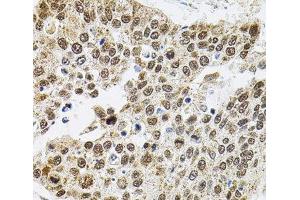 Immunohistochemistry of paraffin-embedded Human lung cancer using BAF60a Polyclonal Antibody at dilution of 1:100 (40x lens). (SMARCD1 抗体)