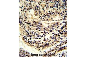 Formalin-fixed and paraffin-embedded human lung carcinoma reacted with BCL2A1 Antibody (Center), which was peroxidase-conjugated to the secondary antibody, followed by DAB staining. (BCL2A1 抗体  (Middle Region))