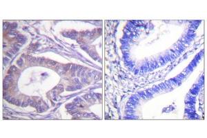 Immunohistochemistry analysis of paraffin-embedded human colon carcinoma tissue, using Vimentin antibody. (Vimentin 抗体  (C-Term))