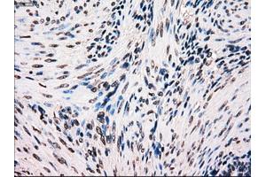 Immunohistochemical staining of paraffin-embedded Carcinoma of kidney tissue using anti-BRAFmouse monoclonal antibody. (BRAF 抗体)