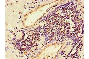 Immunohistochemistry of paraffin-embedded human prostate cancer using ABIN7160009 at dilution of 1:100 (JNK 抗体  (AA 5-300))
