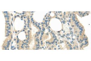 Immunohistochemistry of paraffin-embedded Human thyroid cancer tissue using WNT6 Polyclonal Antibody at dilution 1:35 (WNT6 抗体)
