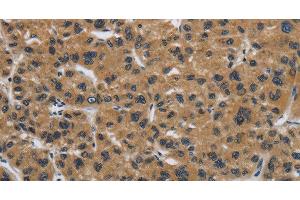 Immunohistochemistry of paraffin-embedded Human liver cancer tissue using Claudin 2 Polyclonal Antibody at dilution 1:50 (Claudin 2 抗体)